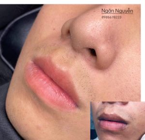 Hình ảnh trước và sau khi khử thâm môi do thương hiệu Ngân Beauty thực hiện cho một vị khách nam 